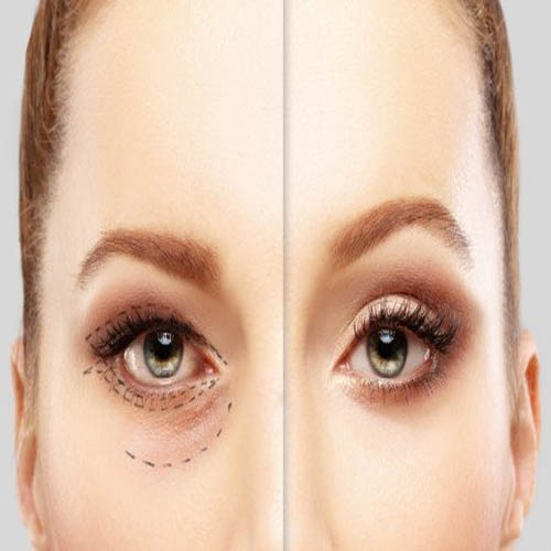 نەشتەرگەری پێڵوو یان