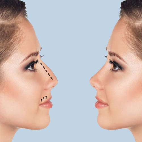 نەشتەرگەری جوانکاری لووت