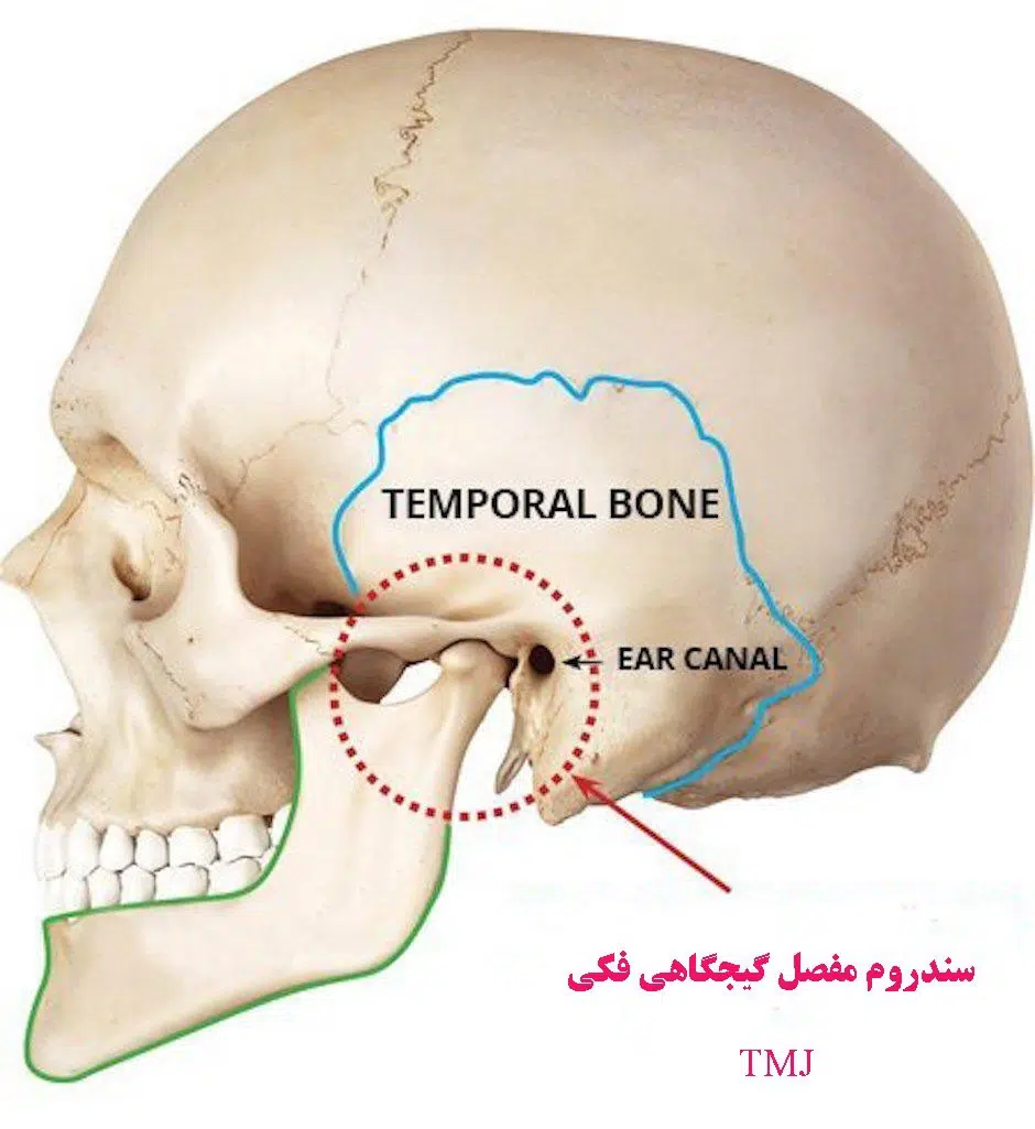 سندرم مفصل فکی گیجگاهی 