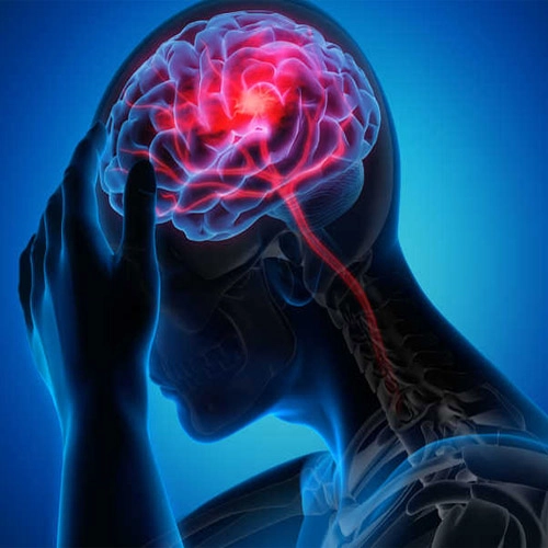 نوع سکته مغزی و عوارض آن‌ه