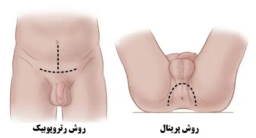 جراحی پروستات