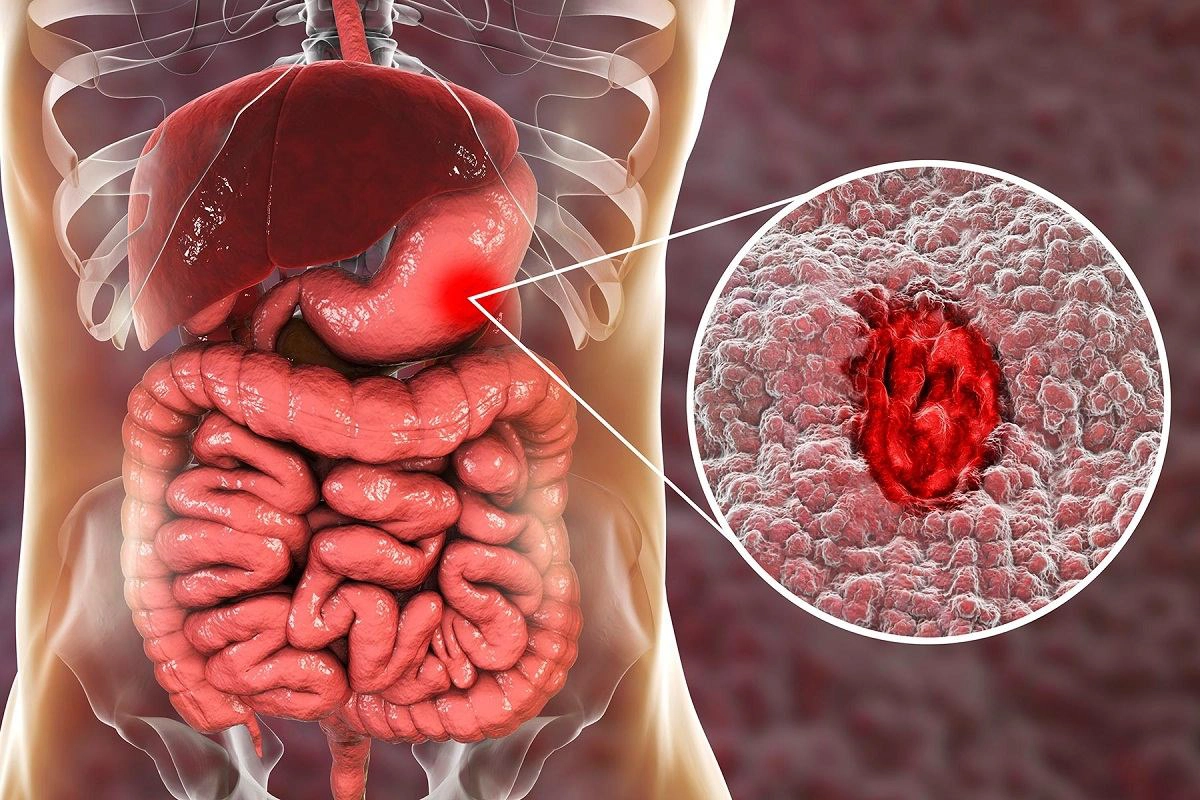 stomache cancer