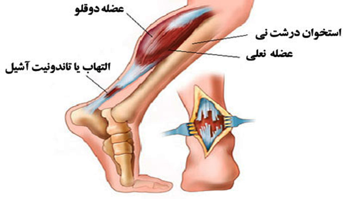 آشیل