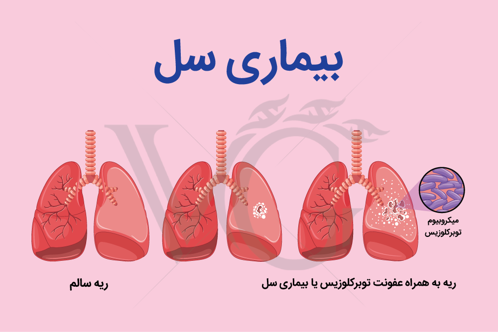 بیماری-سل
