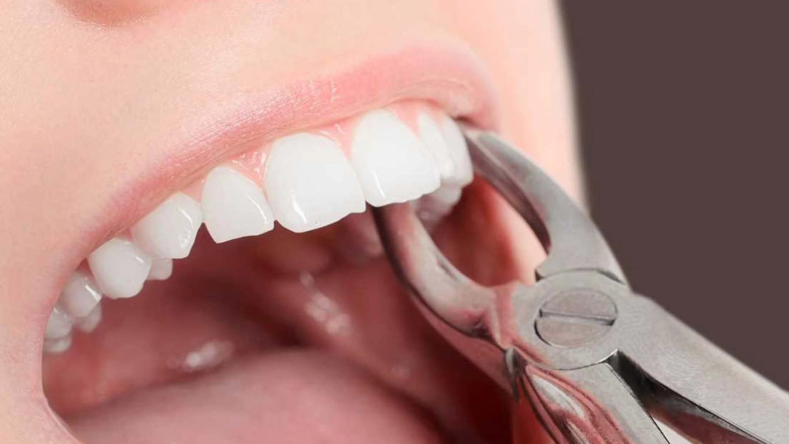 tooth-extraction